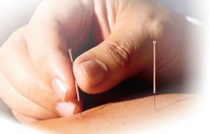 acupuncture