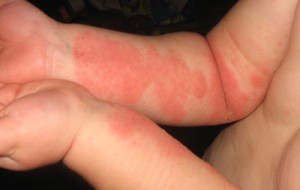 eczema