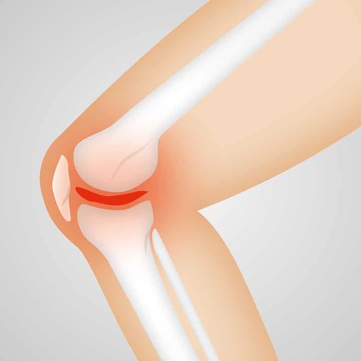 Qu’est-ce qui provoque une crise d’arthrose au genou ?